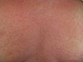 Rash on the chest of a person with anaphylaxis