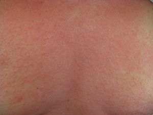 Archivo:Rash on the chest of a person with anaphylaxis
