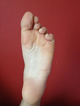 Archivo:Sole of left foot Caucasion