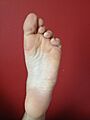 Sole of left foot Caucasion