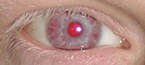 Red (albino) eye.png
