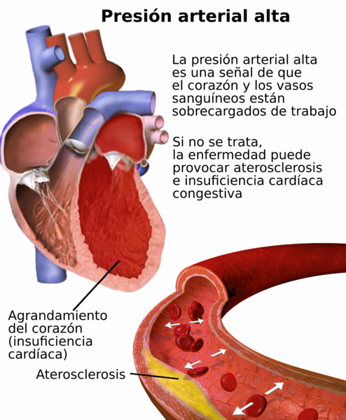 Blausen 0486 HighBloodPressure 01-es