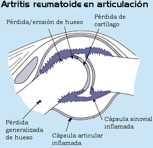 Archivo:Illustration of a joint with rheumatoid arthritis
