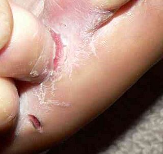 Tinea pedis interdigitalis.jpg