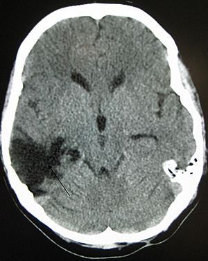 Archivo:Traumaticbraininjury2010