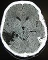 Traumaticbraininjury2010