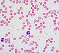 Warm autoimmune hemolytic anemia