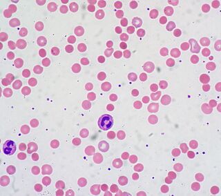 Warm autoimmune hemolytic anemia.jpg