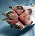 Vasculitis lesions