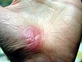 Hand Abrasion - 30 days 4 hours 43 minutes after injury