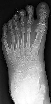 Archivo:Polydactyly 01 Lfoot AP
