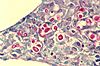 Cryptococcosis of lung in patient with AIDS. Mucicarmine stain 962 lores.jpg