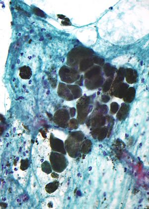 Archivo:Pigmented melanoma - cytology