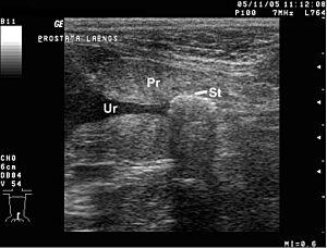 Archivo:Prostatic Urolithiasis