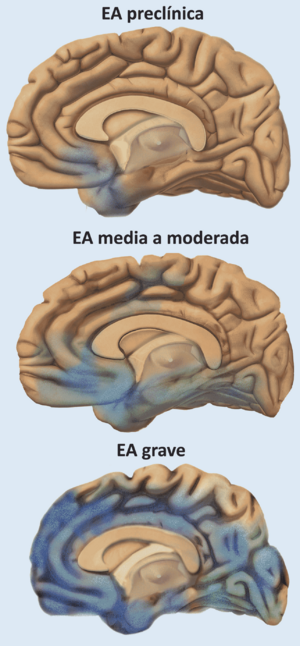 Archivo:Alzheimer’s Disease, Spreads through the Brain (24524716351)-es