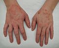 Dermatitis2015