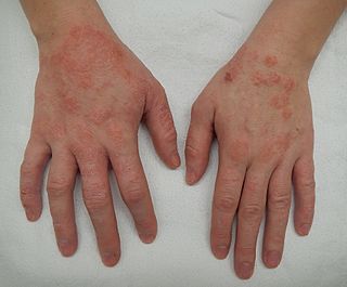 Dermatitis2015.jpg
