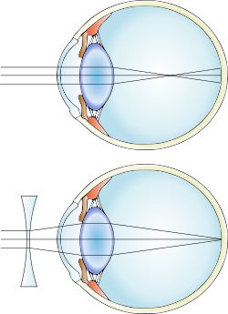 Archivo:Myopia and lens correction