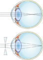 Myopia and lens correction