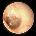 Normal Left Tympanic Membrane