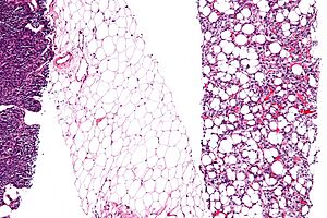 Archivo:Dedifferentiated liposarcoma - intermed mag