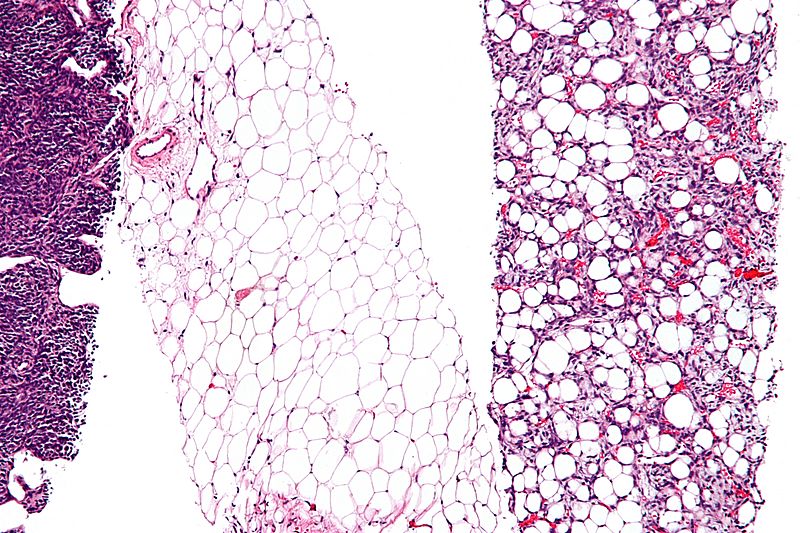 Dedifferentiated liposarcoma - intermed mag