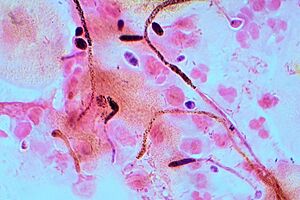 Archivo:Candida Gram stain