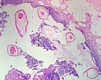 Archivo:Pinworms in the Appendix (1)