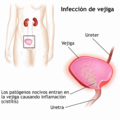 Bladder Infection-es
