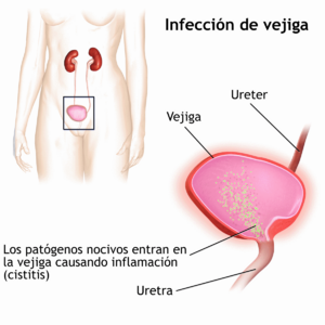 Archivo:Bladder Infection-es