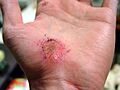 Hand Abrasion - 2 days 22 hours 12 minutes after injury