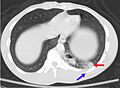 Pulmonary contusion CT arrow