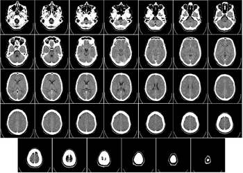 Archivo:CT of brain of Mikael Häggström large