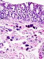 Schistosoma japonicum (1) histopathology