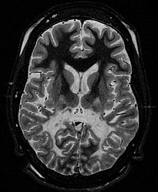 Adrenoleukodystrophy.jpg