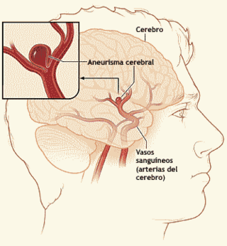 Cerebral aneurysm NIH-es.png