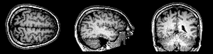 Archivo:BrainMRI3planes