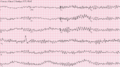 Ventricular fibrillation