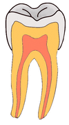 Archivo:Smooth Surface Caries GIF