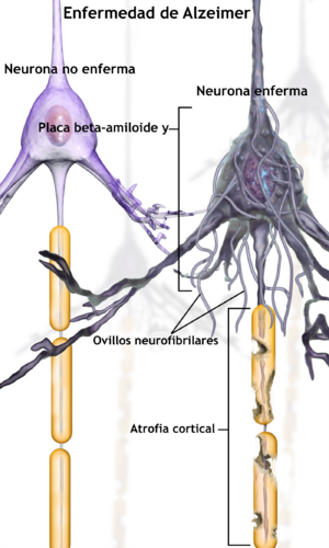 Archivo:Blausen 0017 AlzheimersDisease-es