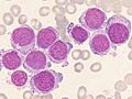 Celulas de Leucemia