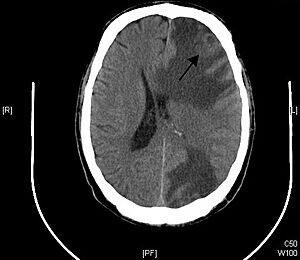 Archivo:Brain - CT scan - Metastatic pulmonary adenocarcinoma Case 239 (7603361920)