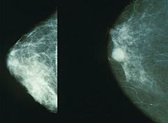Archivo:Mammo breast cancer
