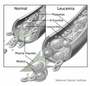 Archivo:Blood cells (normal and leukemia)-es