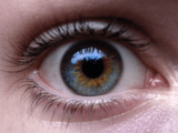 Central Heterochromia Example Blue & Brown