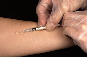 Archivo:Mantoux tuberculin skin test