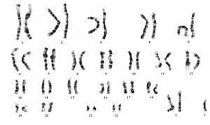 Archivo:Klinefelter's Syndrome XXY DNA