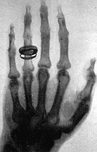 Archivo:X-ray by Wilhelm Röntgen of Albert von Kölliker's hand - 18960123-02