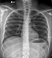Chest X-ray