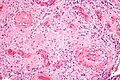 Hypertrophic decidual vasculopathy high mag